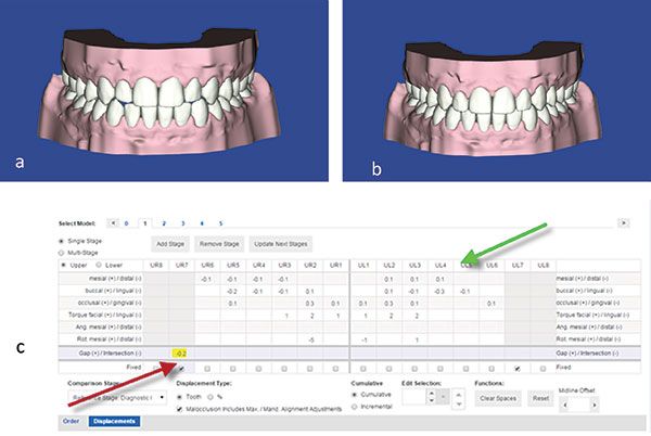 Figures 3A-3C: Designing the target setup. 3A. The virtual working model. 3B. The target setup. 3C. Measures for IPR (red arrow) and tooth displacement (green arrow) are automatically updated as the teeth are moved