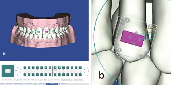 Figures 5A-5B: Attachment selection. 5A. Individual attachments for each tooth can be selected. 5B. The attachments can be positioned to create and manage the required tooth movement