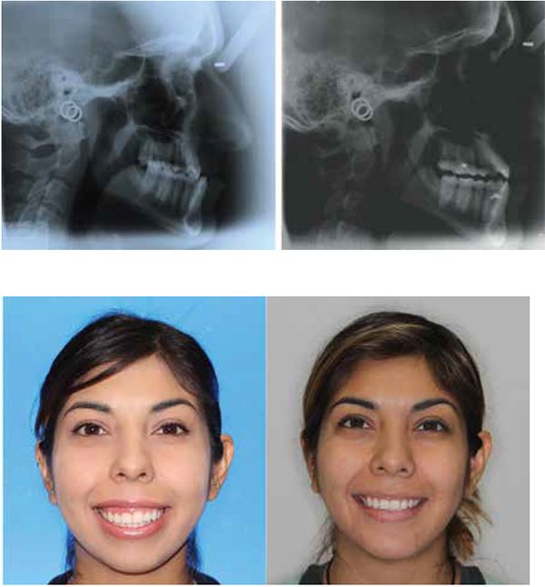 Figure 10: AY maxillary advancement with Invisalign TADs and Class III elastics with AcceleDent 22 months - Nonsurgical; Figure 11: CP non-extraction with surgery AcceleDent and insignia completed in 15 months or 37% faster than the original estimate of 24 months