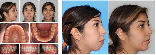 Figure 13: Final for CP; Figure 14: CP profile before and after treatment 15 months with AO and surgery