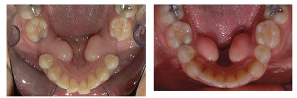 Figure 2: Large 10 mm spaces; Figure 3: 10 mm spaces closed in 8 months PSL, TADs, NiTi springs and 2-3 micro-osteoperforations