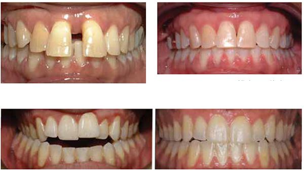 Figure 7: Large 4 mm diastema; Figure 8: Space closed and deep bite improved in 4 months with 1 MOP and PSL mechanics; Figure 9: AY Adult nonsurgical Invisalign before and after with AcceleDent 16 months overall treatment. Estimated 24 months = 35% reduction in treatment time