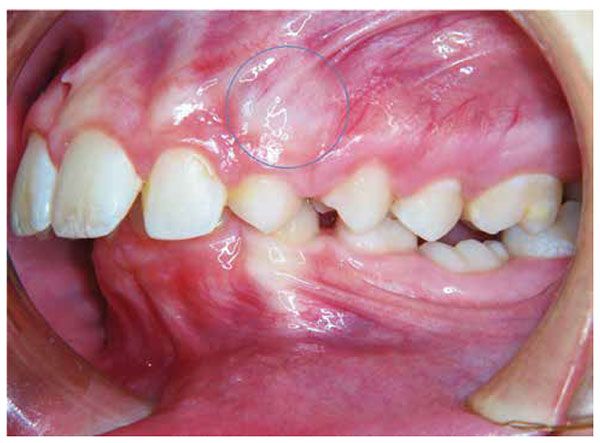 Figure 3: The presence of a canine bulge developing at the age of 9 years and enlarging prior to its eruption is an important milestone in the development of the dentition. Note the blanching of the gingiva above tooth No. 6.3, indicating the advancement and normal eruption of the maxillary permanent canine