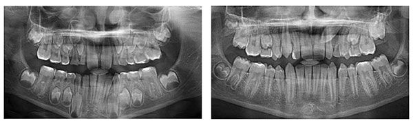 Figure 4A: This 8-year-old patient presented for examination in the early mixed dentition. Note the early overlap of tooth No. 2.3 with the developing tooth No. 2.2. No treatment or intervention was completed at this time; Figure 4B: The same patient returns at the age of 13, now with a palatally displaced tooth No. 2.3 that required surgical exposure