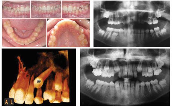 Figure 6A: This 11-year-old patient presented with non-palpable bilateral buccal canine bulges and no mobility of the primary canines. Furthermore, she presented with a half-cusp Class II molar relationship and excessive overjet; Figure 6B: Panoramic radiographic findings show maxillary permanent canines that are overlapping the lateral incisors, a mesial crown angulation (>15 degrees), and minimal physiological root resorption of the primary canines; Figure 6C: A CBCT of the canines confirmed the palatal position of the erupting canines (palatally displaced canines) and confirmed that there was no external root resorption of tooth No. 2.2. Note the lack of physiologic root resorption on tooth No. 6.3; Figure 6D: Preventive treatment consisted of the extractions of the maxillary primary canines in combination with headgear therapy resulting in improved eruption of the PDCs. Note the improved angulation of the erupting canines to the midline when compared to the pretreatment radiograph in Figure 6B