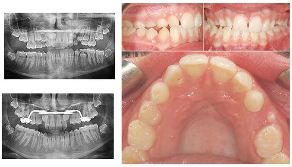 Figure 7A: This 12-year-old female patient presented for examination in the early mixed dentition. Note the significant overlap of both tooth No. 1.3 and No. 2.3 with the maxillary lateral incisors; Figure 7C: Preventive treatment consisted of the extractions of the maxillary primary canines in combination with a rapid palatal expander resulting in improved eruption of the PDCs; Figure 7B: This same patient also presents with a narrow maxillary arch, right posterior crossbite, and significant maxillary and mandibular midline discrepancy