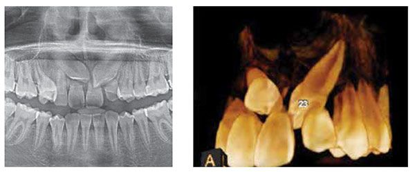 Figure 1A: Panorex of a 12-year-old girl who noted that her maxillary incisors were becoming mobile. Teeth No. 1.3 and No. 2.3 are esioangularly impacted. Significant external resorption of the roots of the maxillary incisors has occurred; Figure 1B: CBCT reconstruction of displaced maxillary canines causing severe resorption of the maxillary incisors. The crown of the impacted tooth No. 2.3 is positioned palatally to the residual root apices of teeth Nos. 2.1 and 2.2 and has caused extensive root resorption of those teeth