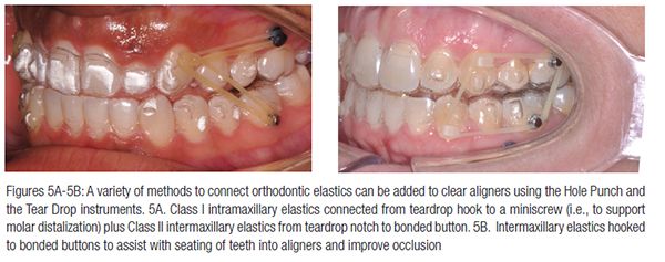 aligner aligners