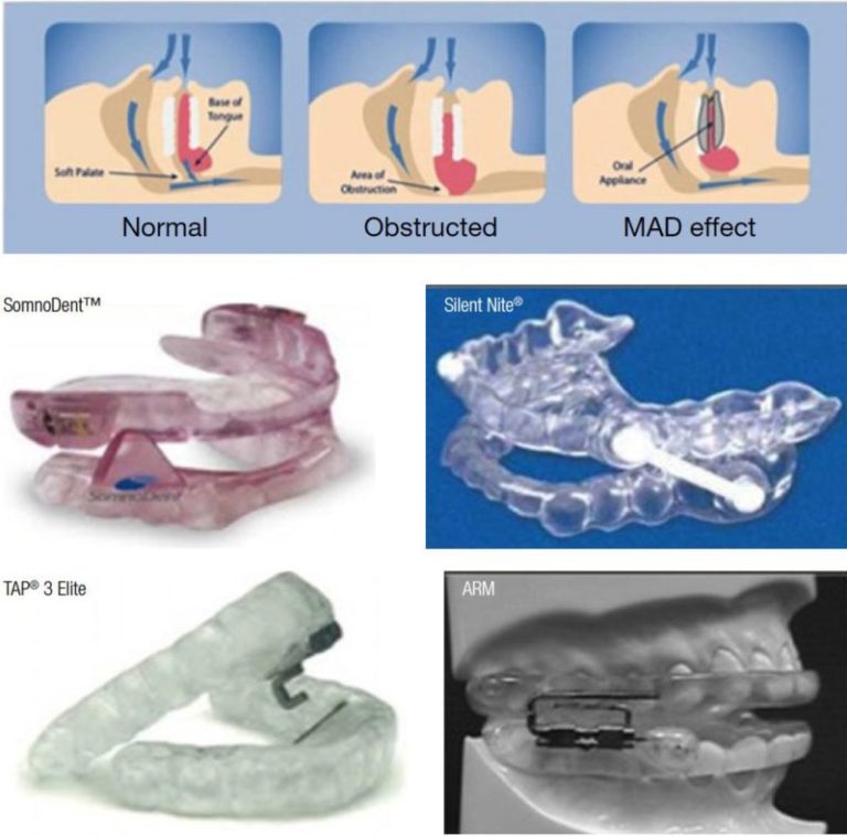 Orthodontic Ce Article A Comparative Review Of Mandibular Advancement Devices And Continuous