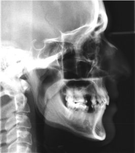 Orthodontic CE Article - Accelerated orthodontics using photobiomodulation