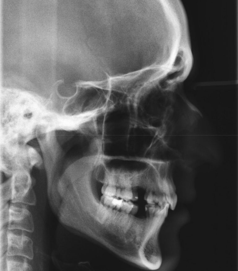 Orthodontic Ce Article - Accelerated Orthodontics Using Photobiomodulation