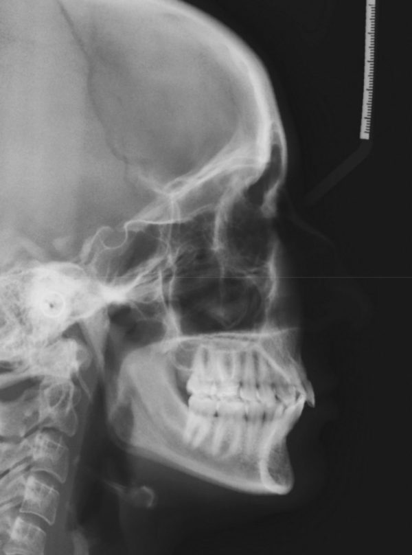 Orthodontic CE Article - Accelerated orthodontics using photobiomodulation