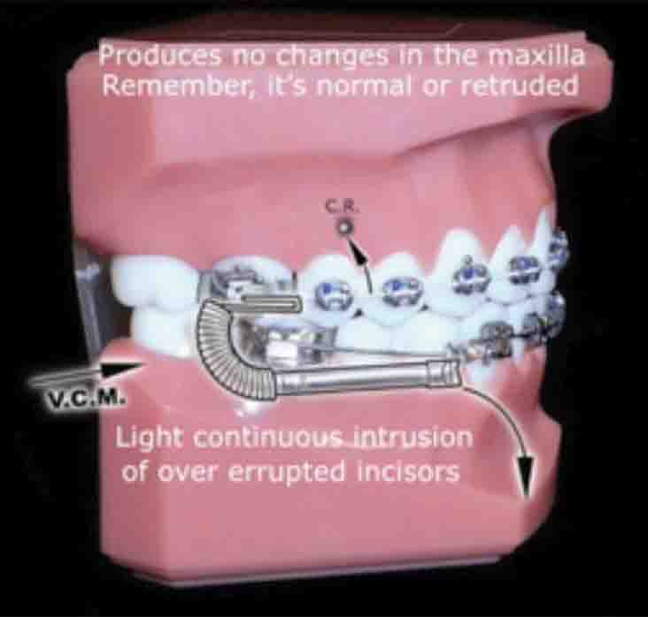 type 3 triangle elastics