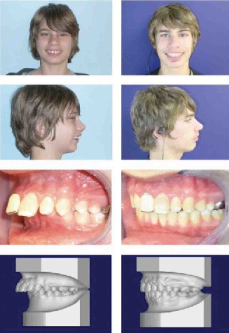 De Fysica Van Klasse Ii Correctie Orthodontische Praktijk Vs Bodytech 