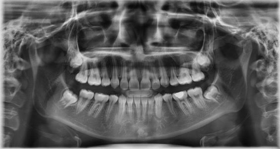 Situational extraction therapy in a challenging patient | Orthodontic ...