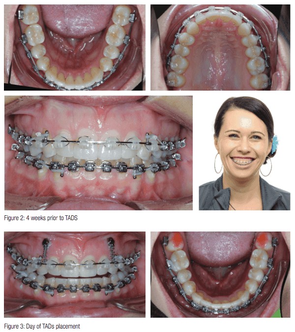 Gummy smile, an often untreated condition Orthodontic Practice US