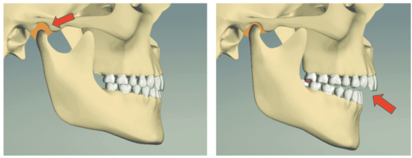 The Fulcrum Effect Musculature Occlusion And The Condylar Position Orthodontic Practice Us