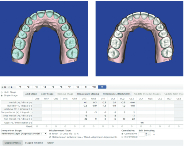 DIY aligners using SureSmile software as a treatment alternative ...