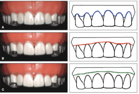 aligner suresmile spacing generalized