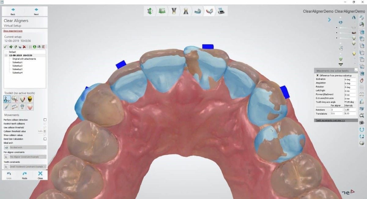 Orthodontic News 3Shape Upgrades its Clear Aligner Studio and