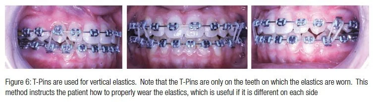 Orthodontic CE Article Vertical slot brackets for increased