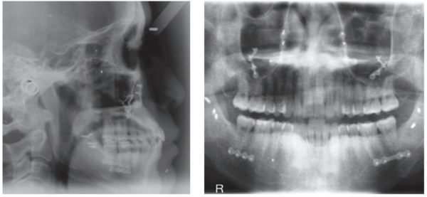 Figure 20: SK final ceph shows stabilization screws and plates for maxilla and mandible; Figure 21: SK final pano shows screws and plates for maxilla and mandible