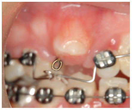 Figure 2I: Links are sequentially cut off leaving 1/8” space from the last link to be tied to the archwire with .025” elastic thread. Here there is only 1 link left on the swivel as the cuspid erupts!