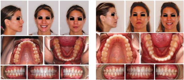 Figure 6 (left): HA progress images at 4 months, resolving crowding with clear aligners with vibration; and Figure 7 (right): HA case refinement at 7 months, more expansion requested