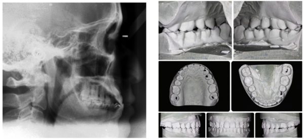 Figure 16 (left): SK initial ceph demonstrates Class III skeletal discrepancy; and Figure 17 (right): SK presurgical models set up created by oral surgeons (LACOMS)
