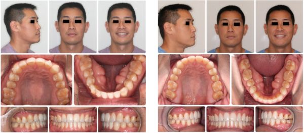 Figures 18 and 19: 18. SK post-surgery pre-case refinement. 19. SK final post-ortho and surgery 19 months overall treatment time with only 10 months of active treatment with clear aligners and vibration with a maxillary and mandibular surgery