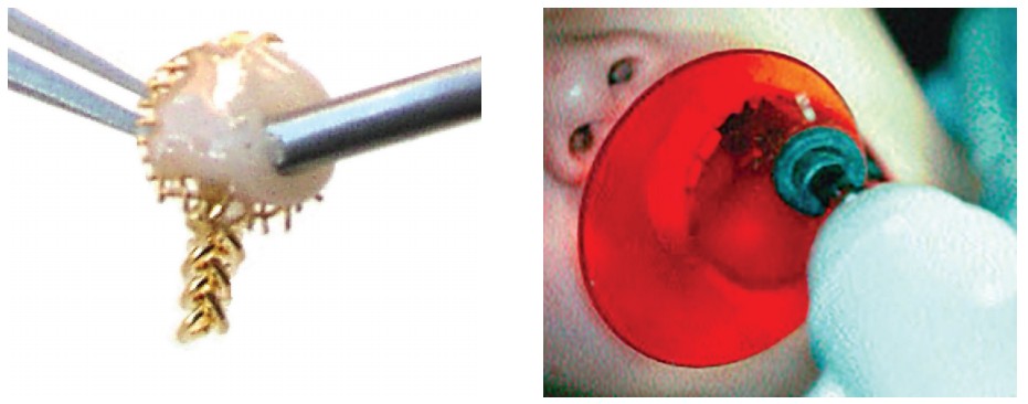 Figures 2E and 2F: 2E. Adhesive is placed on the undersurface of the Gold Mesh Disk. When the disk is placed on the tooth, the adhesive will extrude through and around the mesh. 2F. Light cure polymerizes the adhesive that flows into the etched enamel and also locks around the mesh wires. The Gold Mesh Disk will remain bonded throughout the eruption process