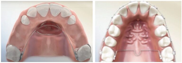 Anchorage Posterior Occlusal Guides — quick and easy posterior ...