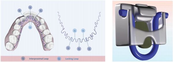 InBrace lingual braces — designed for efficiency