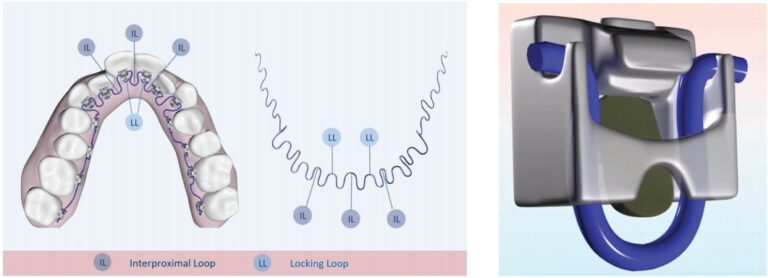 Inbrace Instruments InBrace lingual braces — designed for efficiency