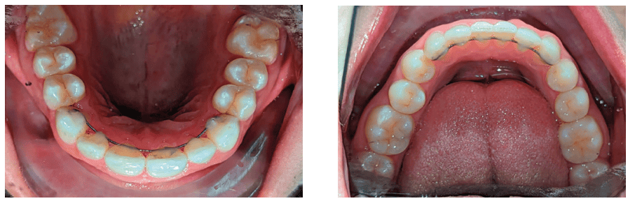 Figures 15 and 16: 15. Occlusal view upon the completion of active treatment.16. Lower occlusal view upon the completion of active treatment
