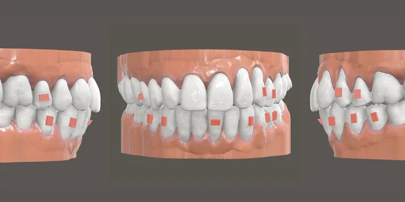 NiTime aligners — wide fit range and consistent forces