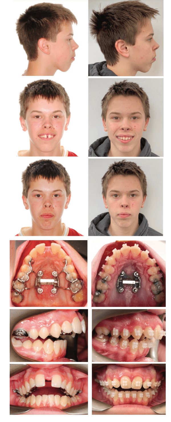 Precision orthodontics achieved for teen patients