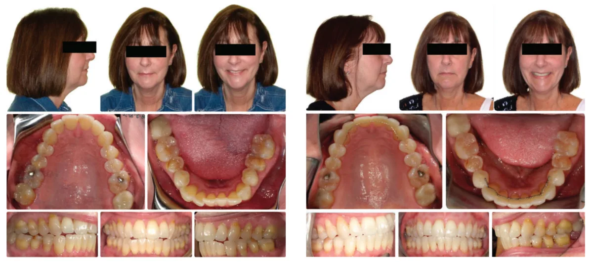 OrthoFX NiTime Aligners — comfort, convenience, and