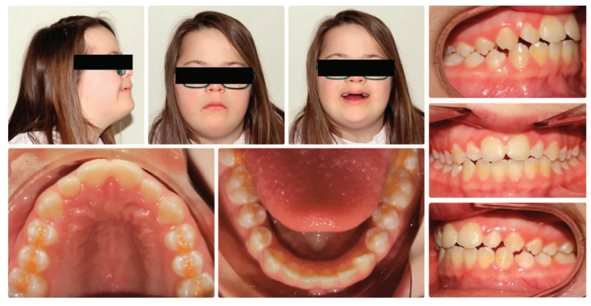 OrthoFX NiTime Aligners — comfort, convenience, and