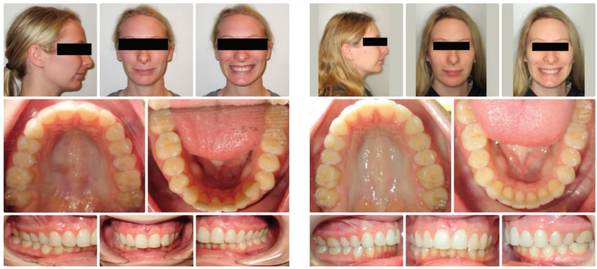 OrthoFX NiTime Aligners — comfort, convenience, and treatment