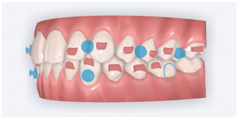 Angel Aligner — transforming approaches to complex cases