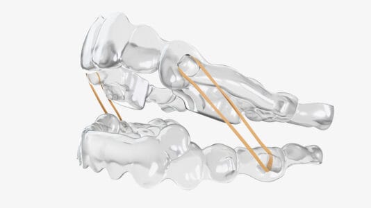 Spark BiteSync UpperLower Elastic Spark BiteSync UpperLower Elastic